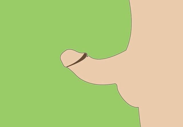 Courbure du pénis comme indication d'agrandissement chirurgical